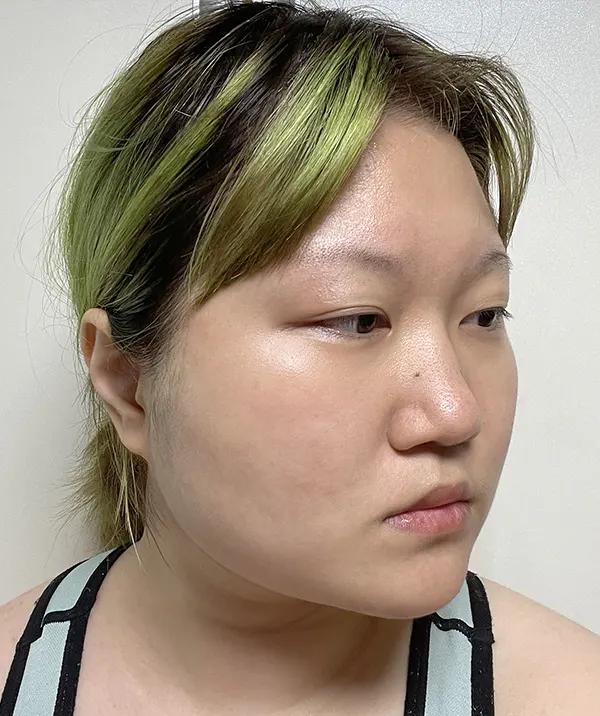 Trước phẫu thuật