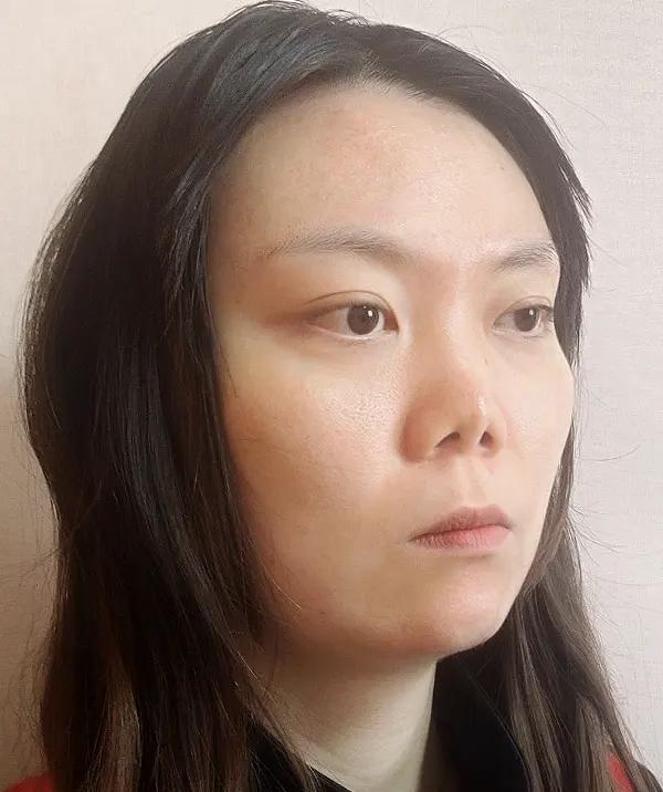 Trước phẫu thuật