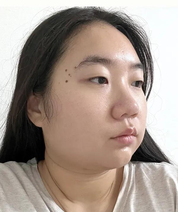 Trước phẫu thuật