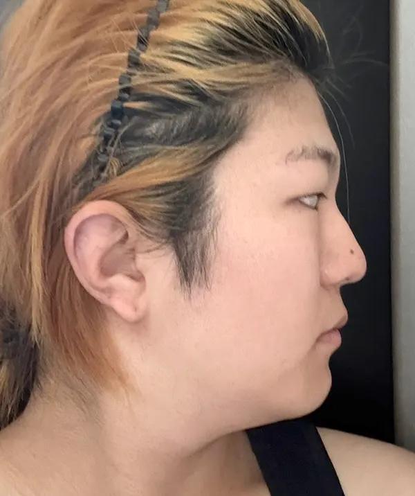 Trước phẫu thuật