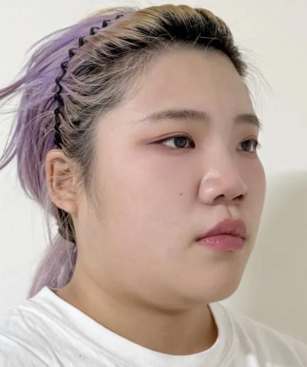 Trước phẫu thuật