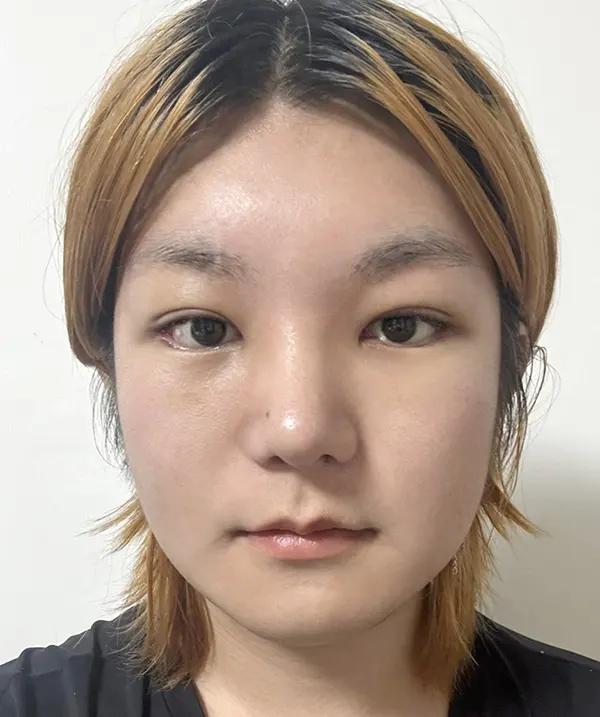 Before and after surgery front view