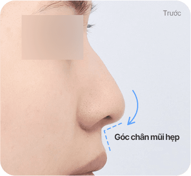 CASE 1. Góc chân mũi hẹp before