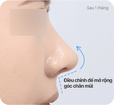 CASE 1. Góc chân mũi hẹp after