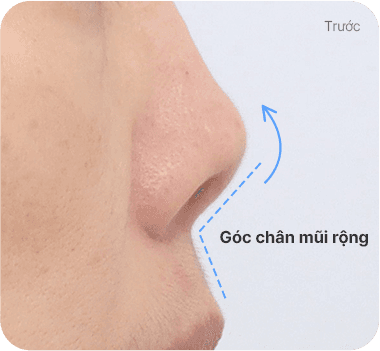 CASE 2. Góc chân mũi rộng before