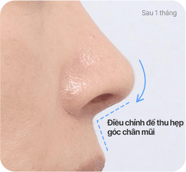 CASE 2. Góc chân mũi rộng after