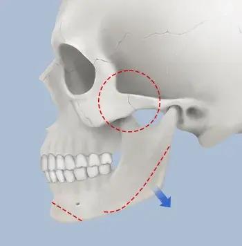 Phẫu thuật đường nét khuôn mặt