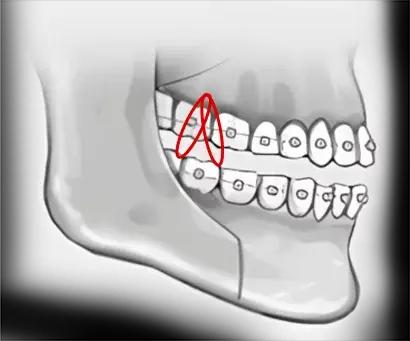 3. Kết quả ổn định nhờ phương pháp cố định bằng dây thun đơn giản