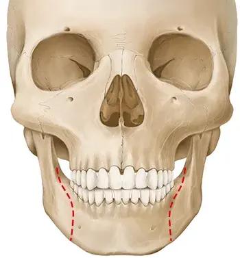 Phương pháp phẫu thuật hàm dưới