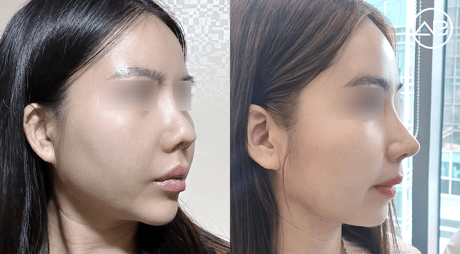 Hành trình sau 2 tháng tái nâng mũi sụn sườn, căng da trán và hút mỡ mặt – Kết quả ngoài mong đợi