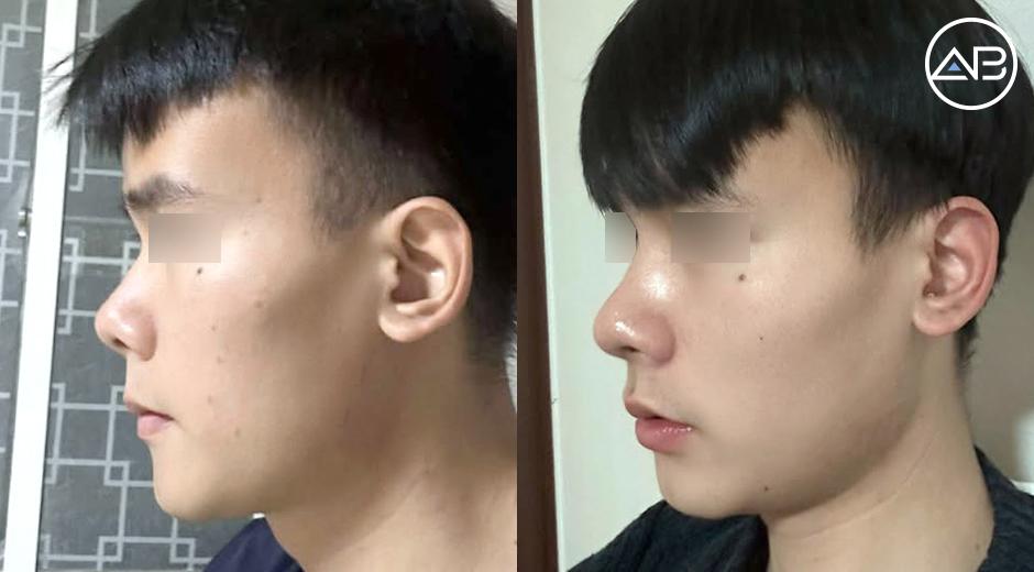 Từ chiếc mũi thấp gãy tự ti đến visual nam tính hơn sau 4 tháng nâng mũi tại AB