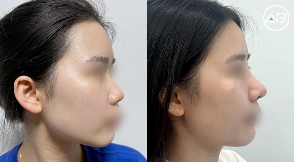Từng tự ti vì mũi thấp tẹt, đầu mũi to và ngắn: Sau 1 tháng nâng mũi sụn sườn tại AB