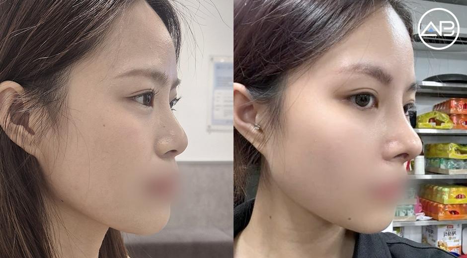 Lần đầu nâng mũi tại Hàn Quốc: Review thật của một du học sinh Việt sau 1 tháng