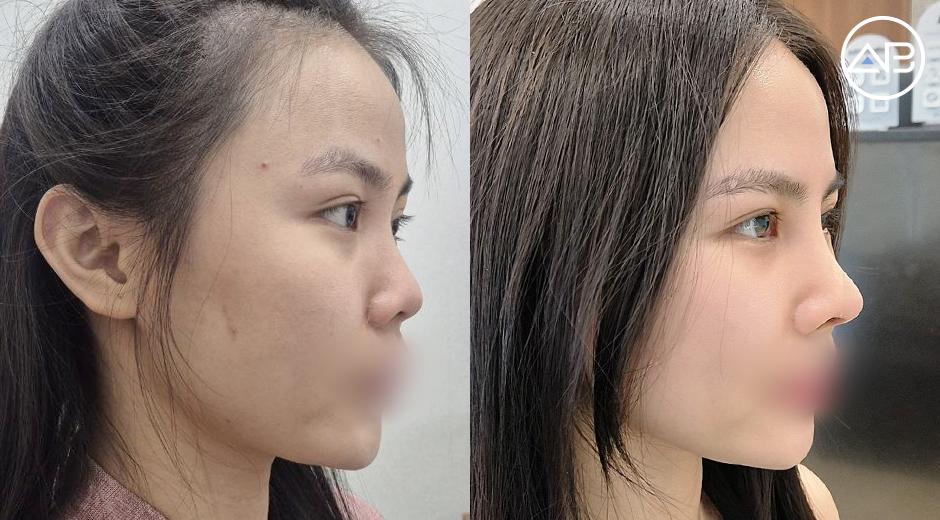 Nâng mũi tại Hàn Quốc sau nhiều năm tự ti vì cắt cánh mũi lỗi: Hành trình thay đổi của một du học sinh Việt
