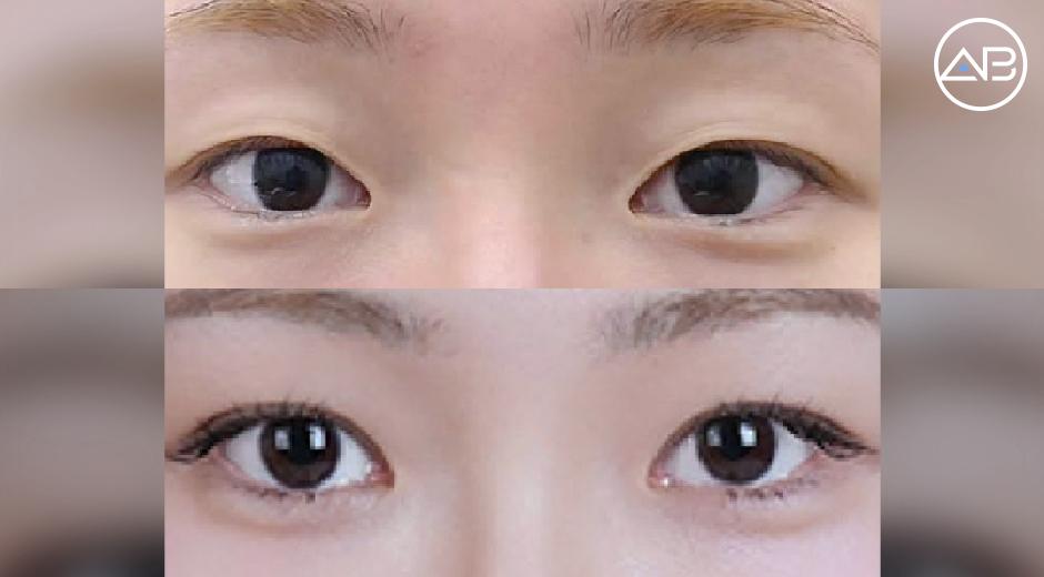Review nhấn mí sau 1 tháng: Mắt hai bên cân đối, tự nhiên hơn sau phẫu thuật
