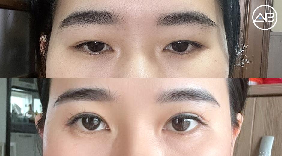 Từ lo lắng sau 7 ngày đến kết quả sau 1 tháng: Hành trình cắt mí đính cơ mí tại AB