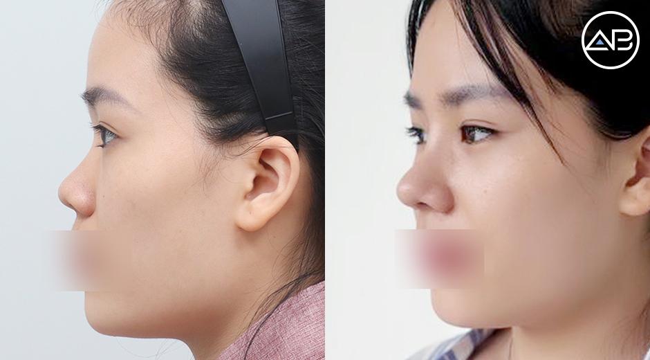 Review nâng mũi tại AB: 7 ngày, 1 tháng và 2 tháng thay đổi ra sao?
