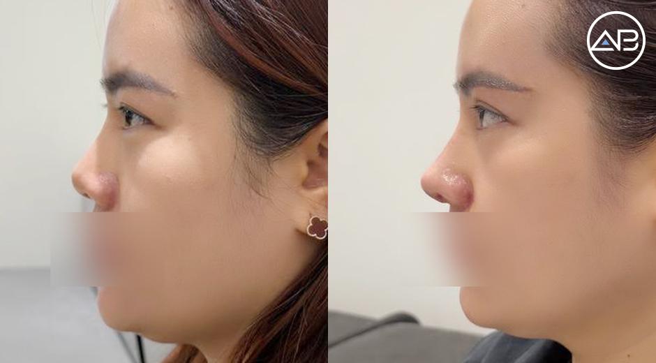 Review tái nâng mũi sụn sườn và treo cung chân mày tại AB