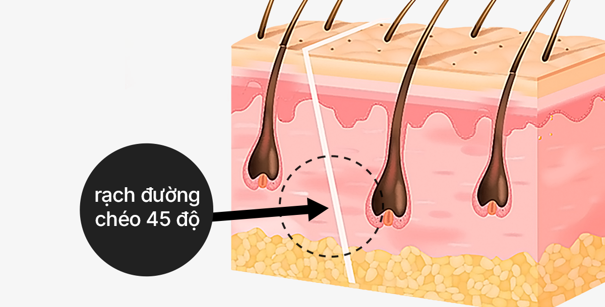 45-degree diagonal incision