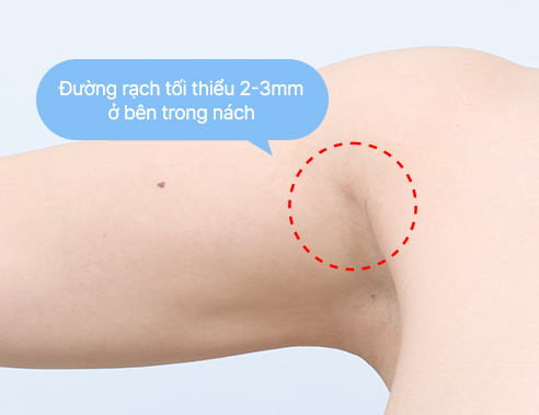 Minimal 2 to 3 mm incision on the inner armpit