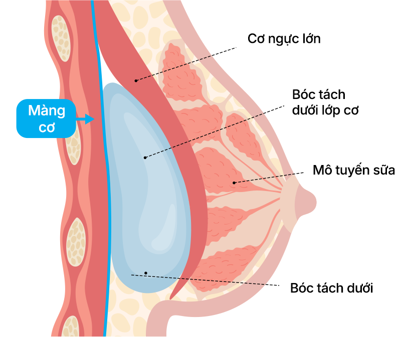 Phương pháp phẫu thuật Dual Plane