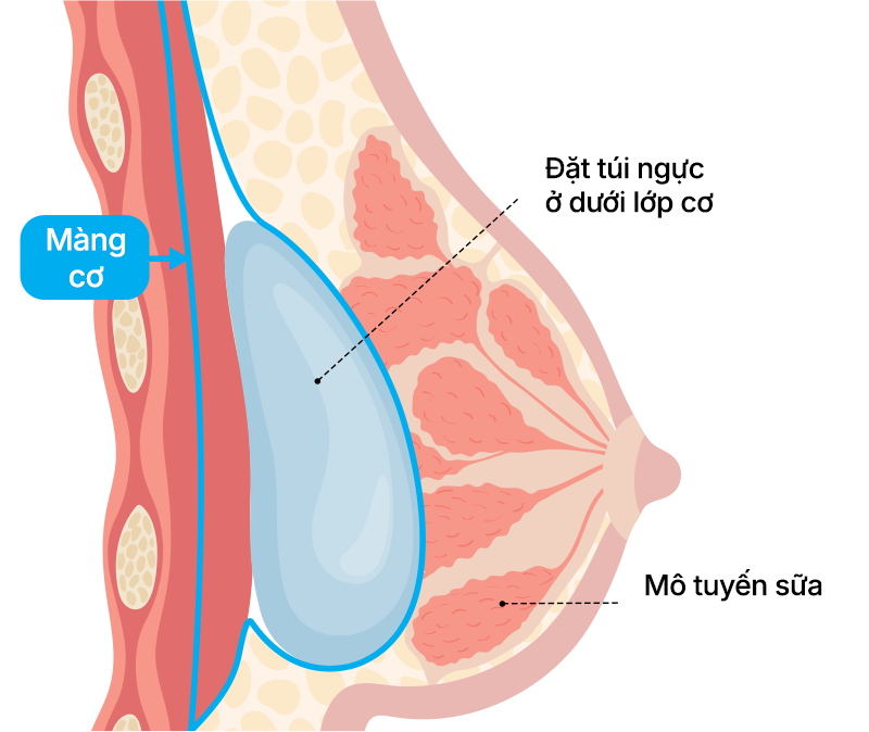 Phương pháp phẫu thuật đặt túi ở dưới lớp màng cơ