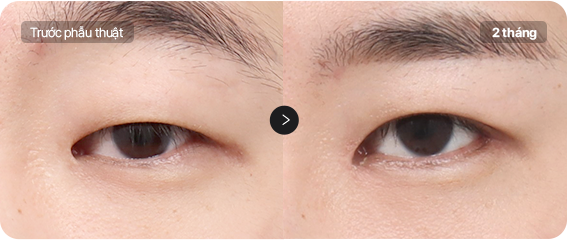 Before and After