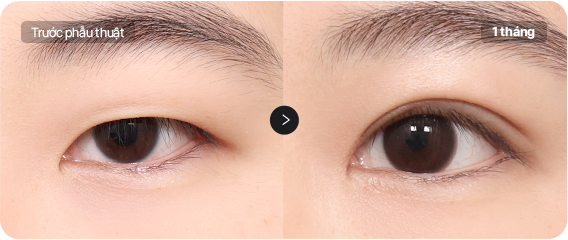 Before and After