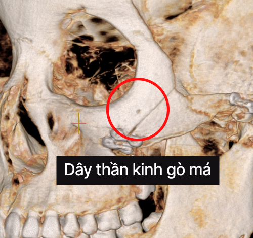 Cắt dạng chữ L