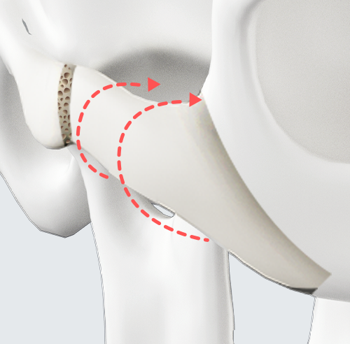 Rotation and Repositioning Inward and Posterior-Superiorly