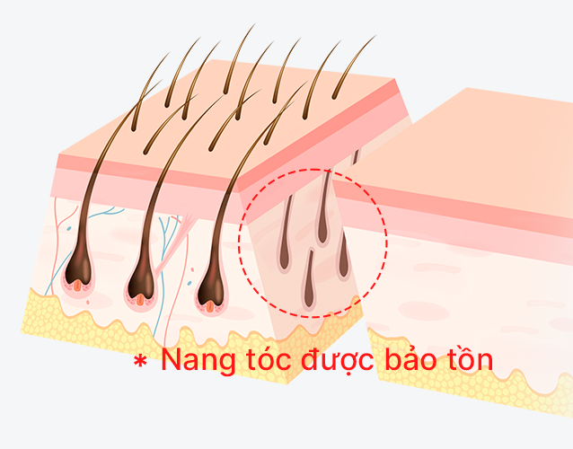 Bảo tồn nang tóc qua đường mổ chéo 45 độ.