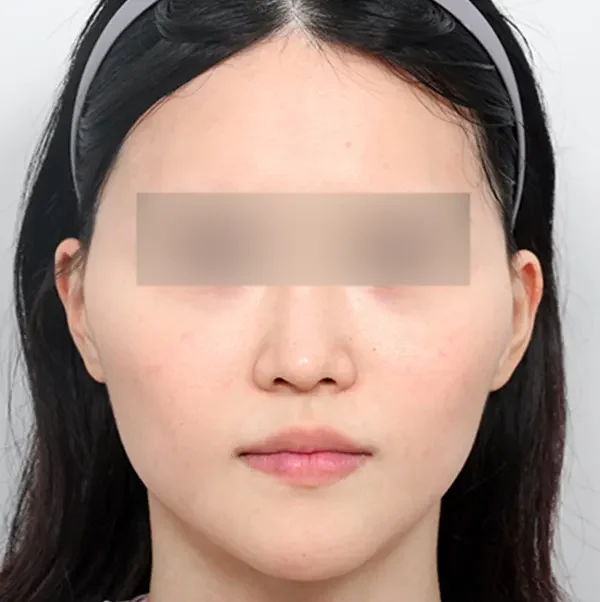 Trước phẫu thuật case 1