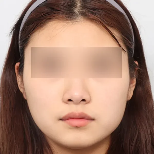 Trước phẫu thuật case 2