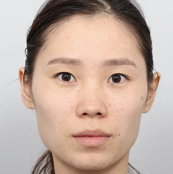 Trước phẫu thuật case 4