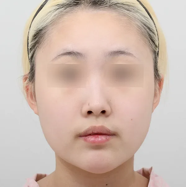 Trước phẫu thuật case 5
