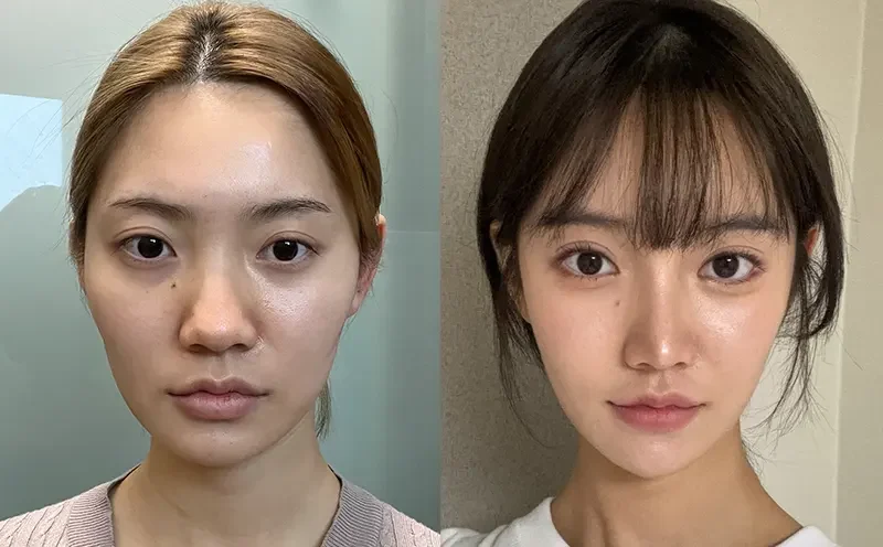 Before and after facial contouring case 2