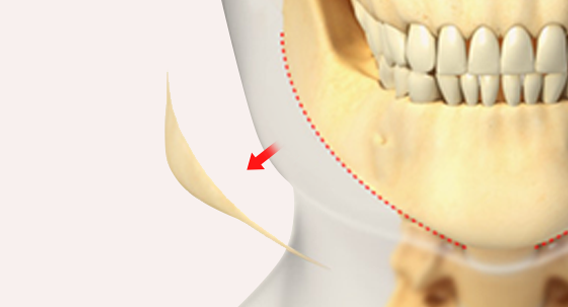 Cắt một đường cong dài để tránh đường viền xương không mượt mà.