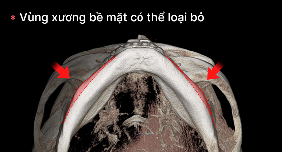 Gọt xương bề mặt bên để khi nhìn góc chính diện đạt hiệu quả cao.