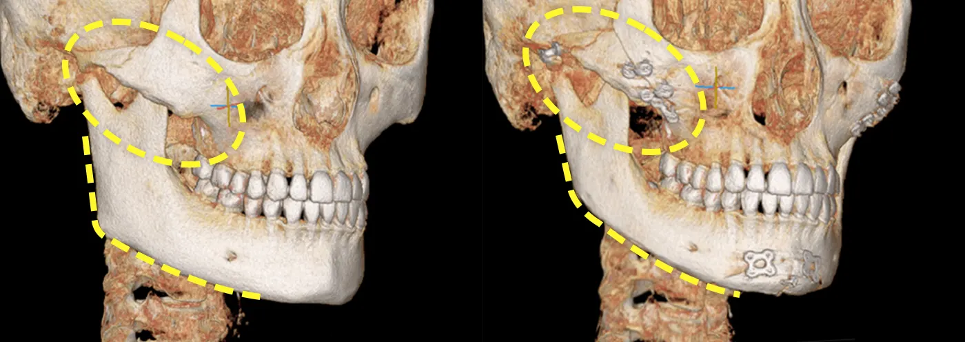 맥미걸 악플콜렉터 수술 전후 ct 사진