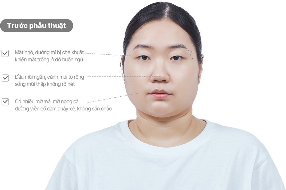 맥미걸 악플콜렉터 얼굴 수술 전 문제점과 개선점