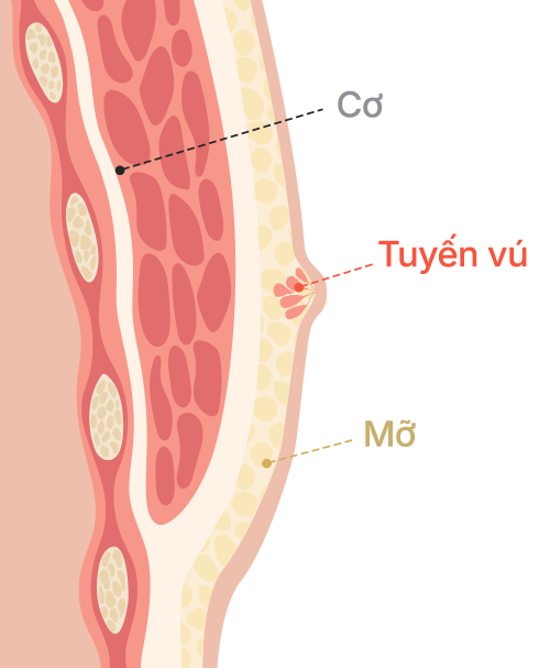 Gynecomastia surgery