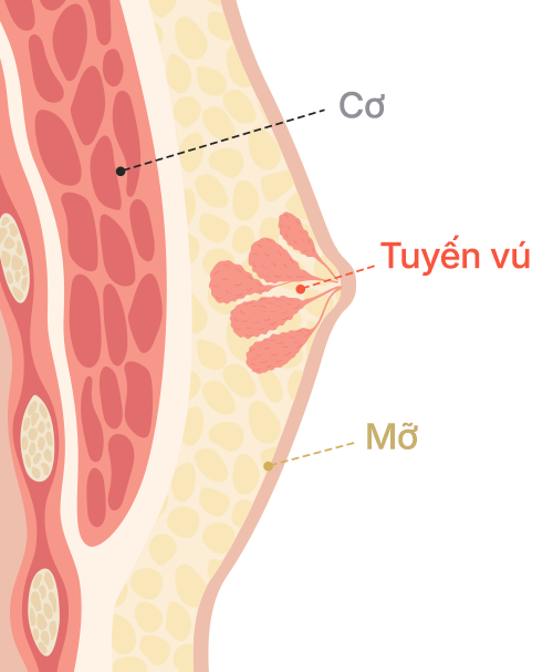 Gynecomastia surgery