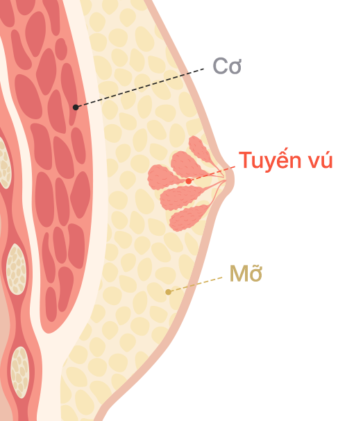 Gynecomastia surgery