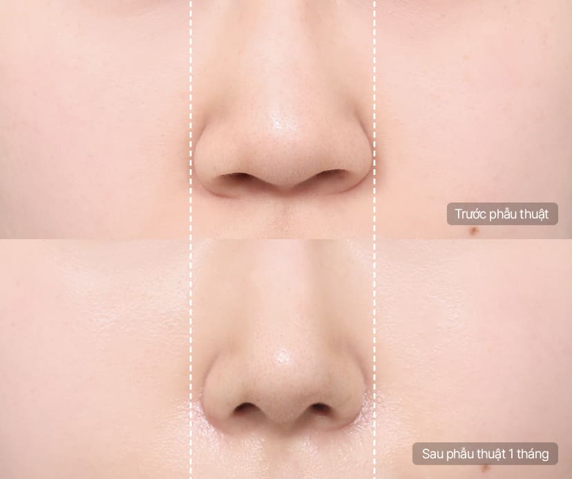 Thu nhỏ cánh mũi