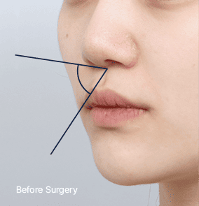 Trước phẫu thuật