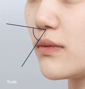 Trước phẫu thuật