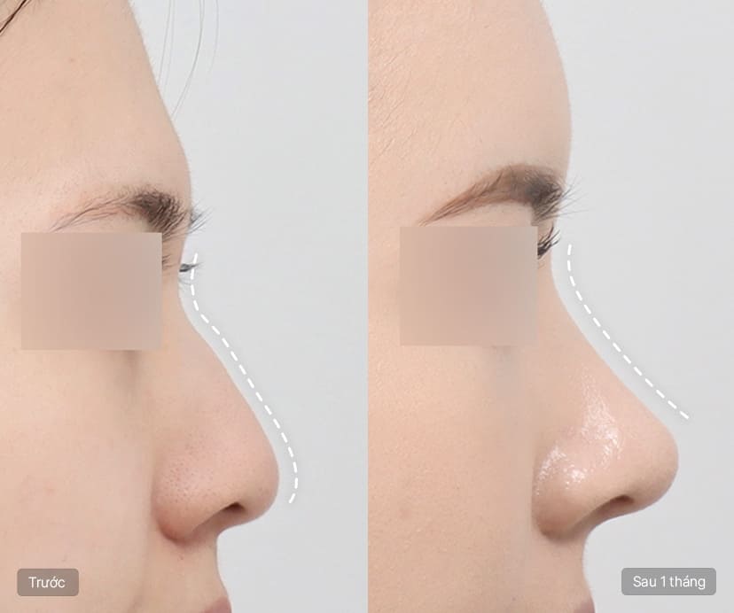 Nâng mũi không sụn cấy ghép