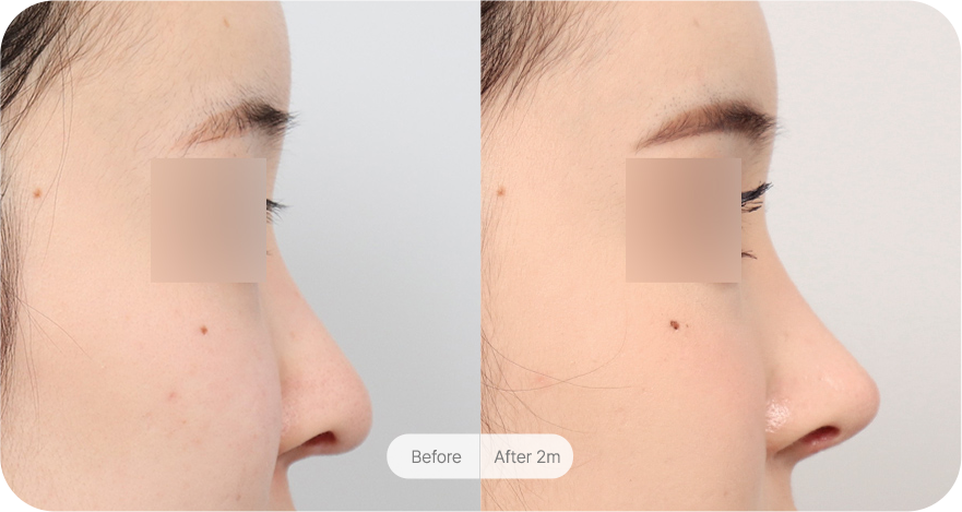 revision-rhinoplasty