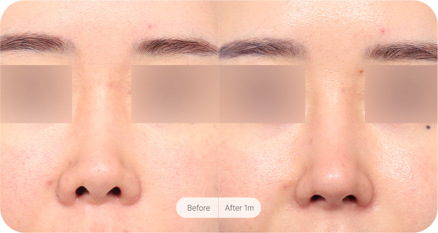 revision-rhinoplasty