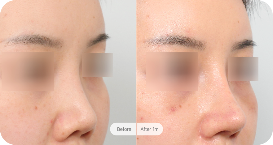 revision-rhinoplasty